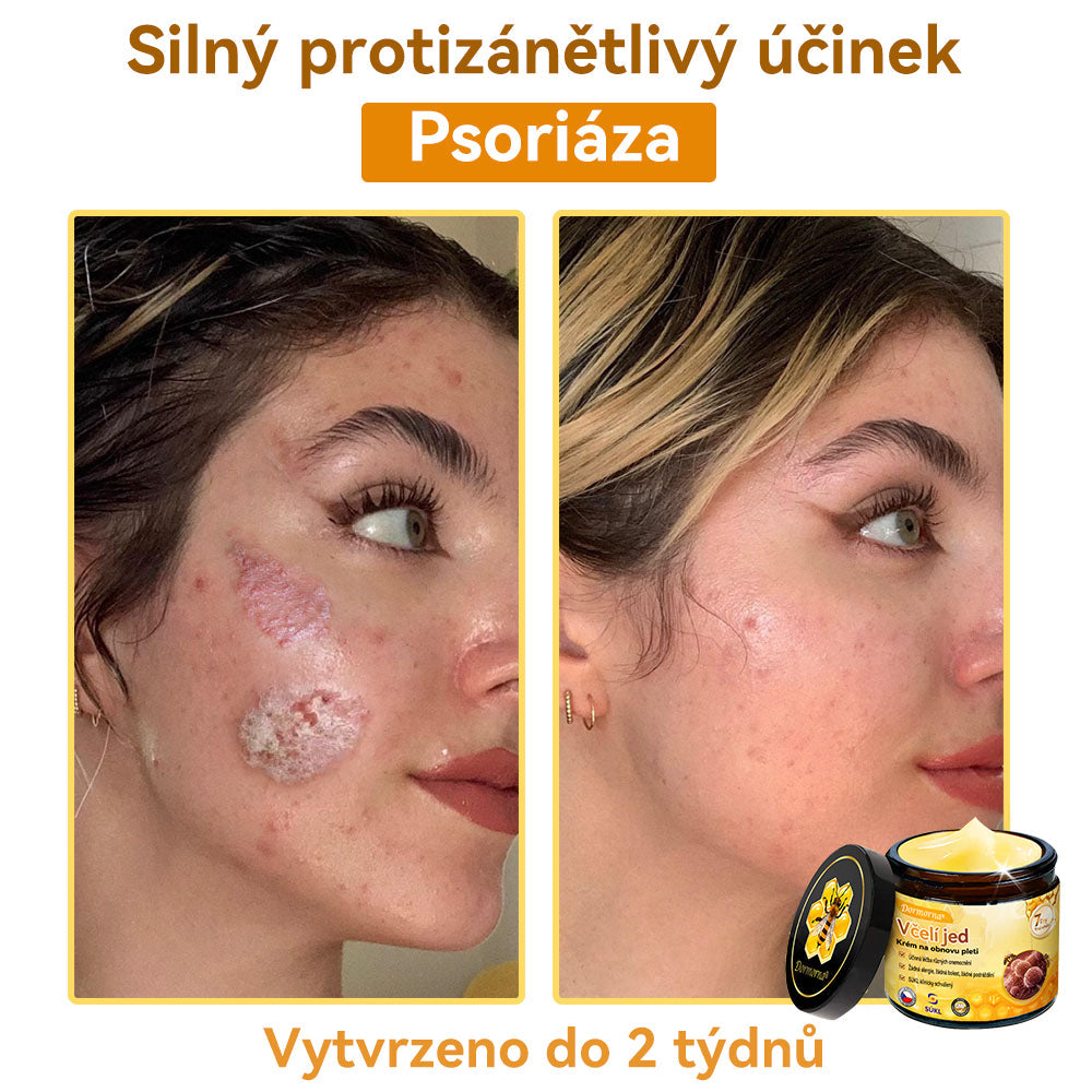 [💯Bez bolesti-bez vedlejších účinků] 𝐃𝐨𝐫𝐦𝐨𝐫𝐧𝐚®💥💥𝐕č𝐞𝐥í 𝐣𝐞𝐝 𝐊𝐫é𝐦 𝐧𝐚 𝐨𝐛𝐧𝐨𝐯𝐮 𝐩𝐥𝐞𝐭𝐢- POSLEDNÍ DEN SLEVA 70%