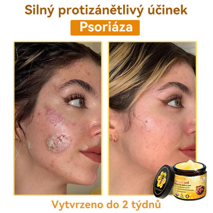 [💯Bez bolesti-bez vedlejších účinků] 𝐃𝐨𝐫𝐦𝐨𝐫𝐧𝐚®💥💥𝐕č𝐞𝐥í 𝐣𝐞𝐝 𝐊𝐫é𝐦 𝐧𝐚 𝐨𝐛𝐧𝐨𝐯𝐮 𝐩𝐥𝐞𝐭𝐢- POSLEDNÍ DEN SLEVA 70%