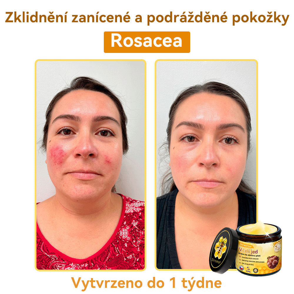 [💯Bez bolesti-bez vedlejších účinků] 𝐃𝐨𝐫𝐦𝐨𝐫𝐧𝐚®💥💥𝐕č𝐞𝐥í 𝐣𝐞𝐝 𝐊𝐫é𝐦 𝐧𝐚 𝐨𝐛𝐧𝐨𝐯𝐮 𝐩𝐥𝐞𝐭𝐢- POSLEDNÍ DEN SLEVA 70%