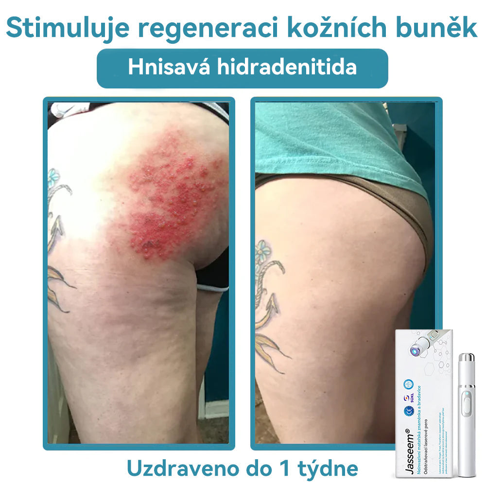 [✅Viditelné výsledky již za 7 dní] 𝐉𝐚𝐬𝐬𝐞𝐞𝐦® 🔥🔥 𝐍𝐞𝐢𝐧𝐯𝐚𝐳𝐢𝐯𝐧í 𝐦𝐚𝐭𝐞ř𝐬𝐤á 𝐳𝐧𝐚𝐦é𝐧𝐤𝐚 𝐚 𝐛𝐫𝐚𝐝𝐚𝐯𝐢𝐜𝐞 𝐎𝐝𝐬𝐭𝐫𝐚ň𝐨𝐯𝐚𝐜í 𝐥𝐚𝐬𝐞𝐫𝐨𝐯é 𝐩𝐞𝐫𝐨 🎉Doporučení dermatologové v České republice