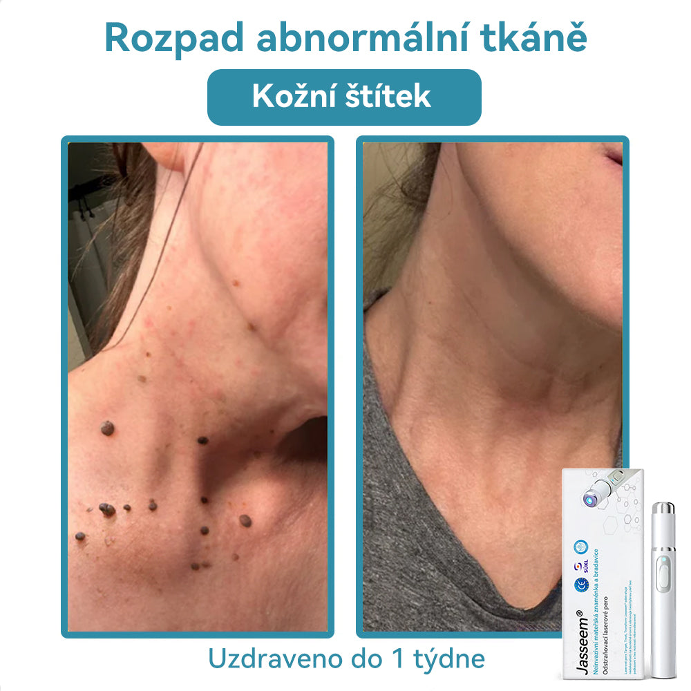 [✅Viditelné výsledky již za 7 dní] 𝐉𝐚𝐬𝐬𝐞𝐞𝐦® 🔥🔥 𝐍𝐞𝐢𝐧𝐯𝐚𝐳𝐢𝐯𝐧í 𝐦𝐚𝐭𝐞ř𝐬𝐤á 𝐳𝐧𝐚𝐦é𝐧𝐤𝐚 𝐚 𝐛𝐫𝐚𝐝𝐚𝐯𝐢𝐜𝐞 𝐎𝐝𝐬𝐭𝐫𝐚ň𝐨𝐯𝐚𝐜í 𝐥𝐚𝐬𝐞𝐫𝐨𝐯é 𝐩𝐞𝐫𝐨 🎉Doporučení dermatologové v České republice