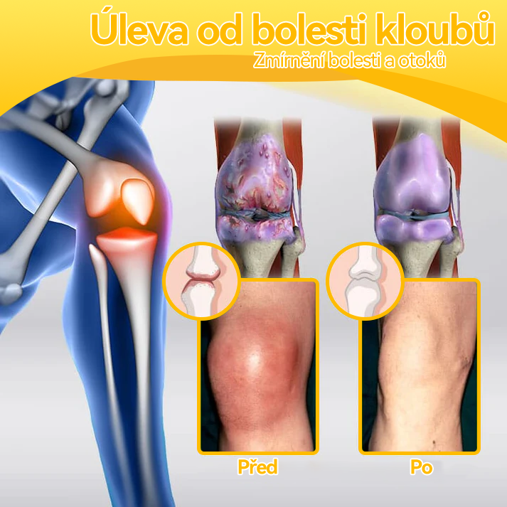 [✅ Oficiální obchod]: 𝐒𝐩𝐳𝐯™ 🌏🌏 Krém na léčbu kloubů a kostí s včelím jedem 🐝 (Novozélandský včelí extrakt, specializovaný na ortopedická onemocnění a bolesti při artritidě)